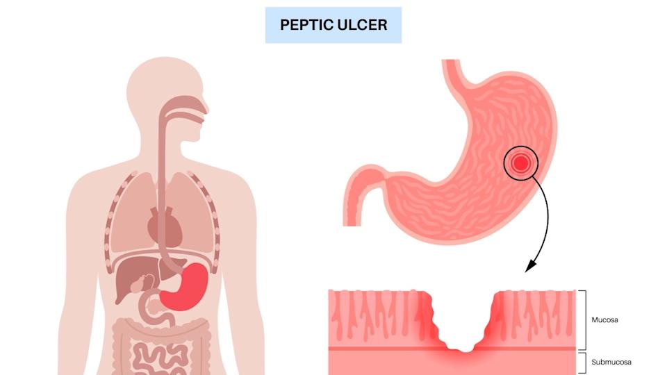 Peptic Ulcer Symptoms